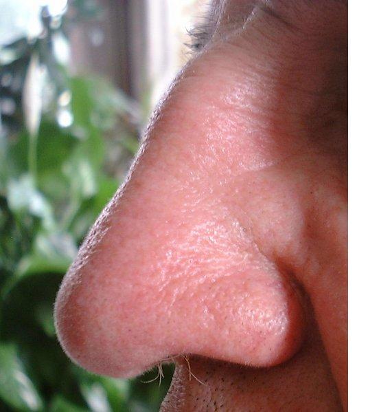 allergic rhinitis/ nasal polyps / sinus infection: are the most common cause 